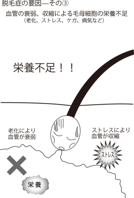 脱毛症の要因その③