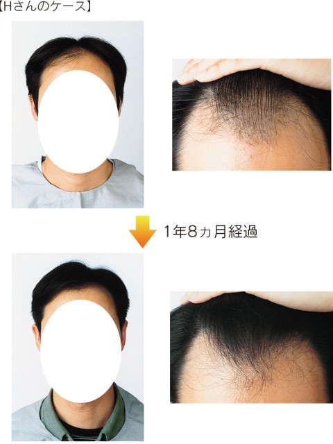 Hさんのケース