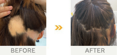 他の広がっていた脱毛部分は毛が生えて、髪がなかったのが嘘の様に