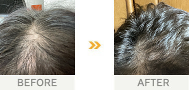 育毛デトックス17回目頃から急に髪が生え、驚きました。